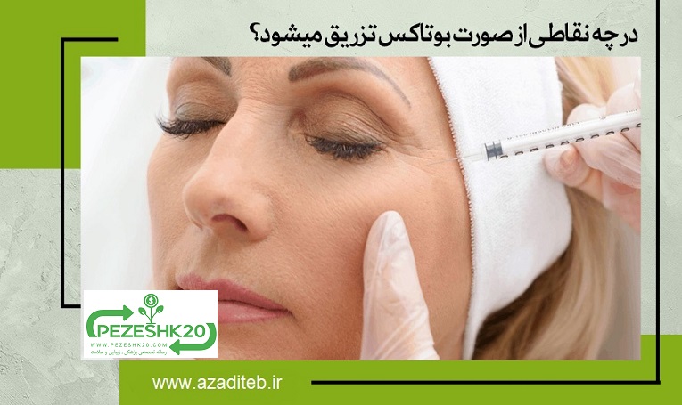 در چه نقاطی از صورت بوتاکس تزریق میشود؟