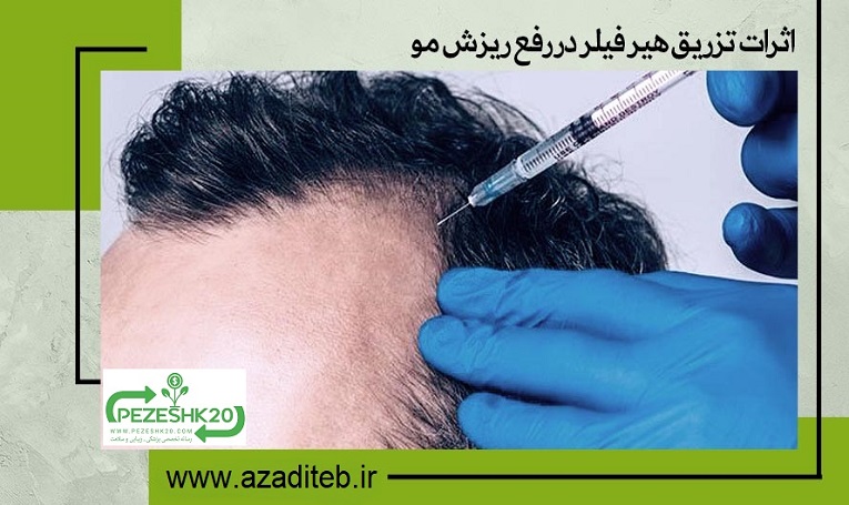 اثرات تزریق هیر فیلر در رفع ریزش مو