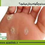میخچه چیست و چگونه درمان میشود؟