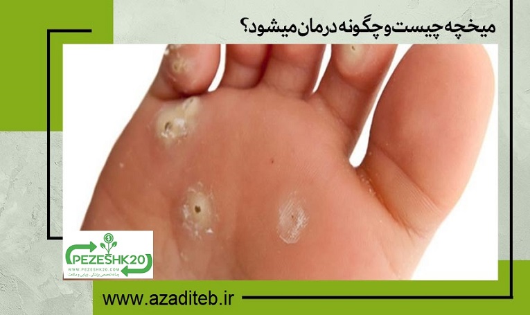 میخچه چیست و چگونه درمان میشود؟