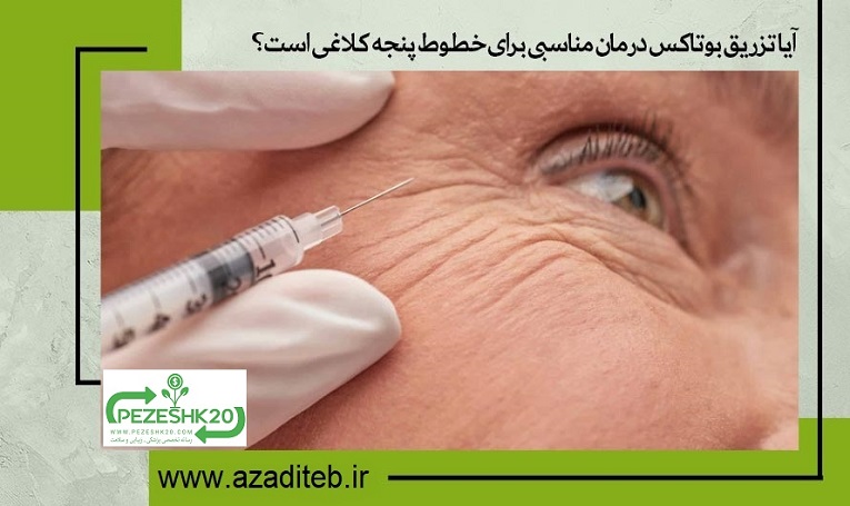 آیا تزریق بوتاکس درمان مناسبی برای خطوط پنجه کلاغی است؟
